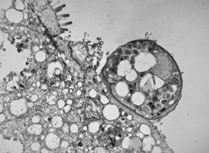 M,33y. | cryptosporidiosis - duodenum, im | munodeficient pacient